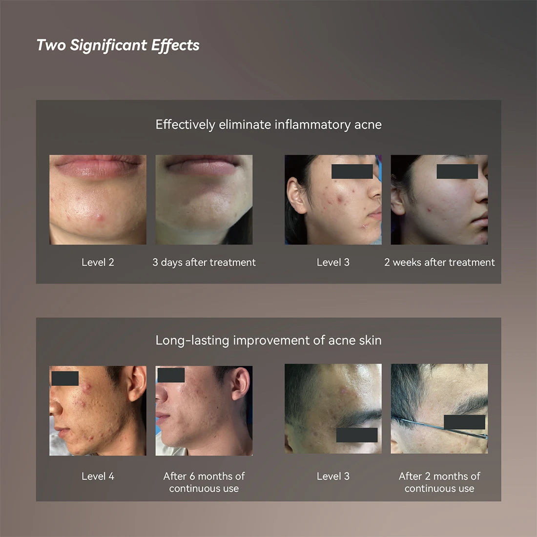 2024 Personal Beauty Product FACE Acne NEW Technology Cold Plasma Pore Face Blackhead Cleaner Kit for Face